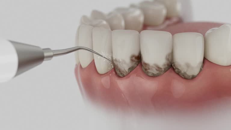 Reliable Wisdom Tooth Removal contractor in Greene County County, OH by Dentist Open Now